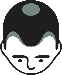 Advanced Hair loss
